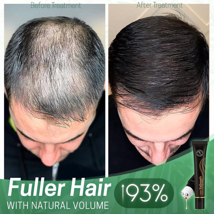 FollikelHerstel™ - Biologische Haargroei Serum Roller - krachtig kruidenserum - versterkt en revitaliseert je haar vanaf de wortel - huishoudmeester